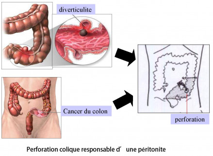 découvrez les différentes complications post-opératoires, leurs causes, symptômes et traitements pour mieux comprendre les risques liés à une intervention chirurgicale.