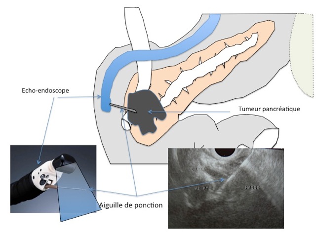 découvrez les techniques endoscopiques novatrices utilisées pour diagnostiquer et traiter les maladies digestives. apprenez comment ces procédures minimement invasives améliorent la prise en charge des patients et favorisent une récupération rapide.