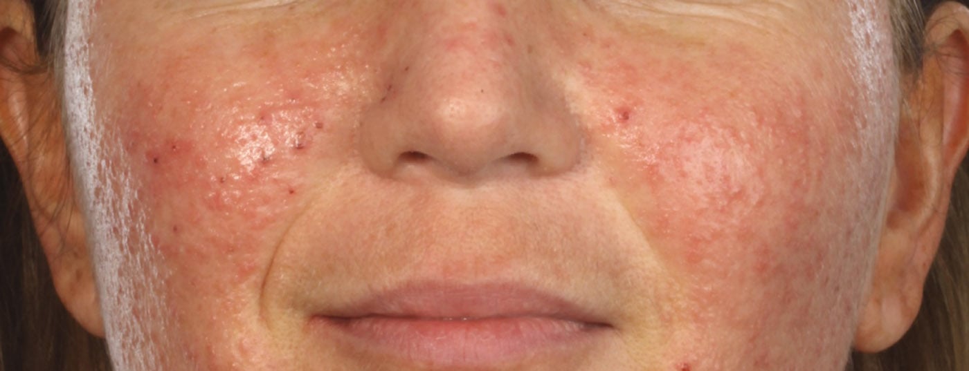 discover the side effects of doxycycline, a commonly used antibiotic. learn about possible reactions, precautions to take, and when to consult a healthcare professional to ensure your safety during its use.